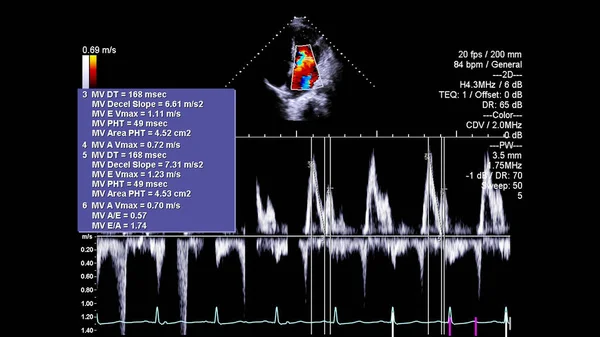 Image of the heart in gray-scale mode during transesophageal ultrasound.