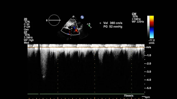 Изображение Сердца Время Трансофагеального Ультразвука Доплеровским Режимом — стоковое фото