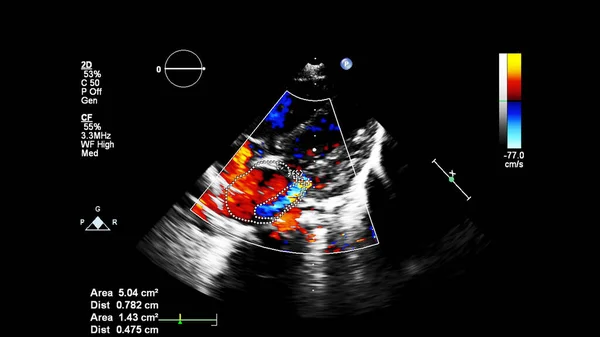 Bild Des Herzens Beim Transesophagealen Ultraschall Mit Doppler Modus — Stockfoto