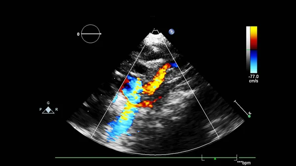 Transesofageal ultrason sırasında Doppler kipi ile kalbin görüntüsü.
