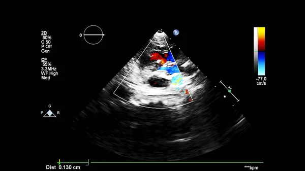 Bild Des Herzens Beim Transesophagealen Ultraschall Mit Doppler Modus — Stockfoto