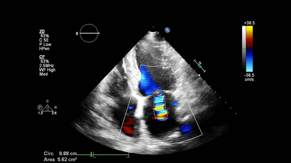 Beeld Van Het Hart Tijdens Transesofageale Echografie Met Doppler Modus — Stockfoto