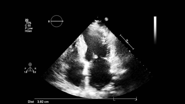 Image of the heart in gray-scale mode during transesophageal ultrasound.