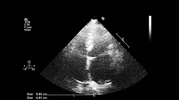 Image Cœur Mode Gris Lors Une Échographie Transœsophagienne — Photo