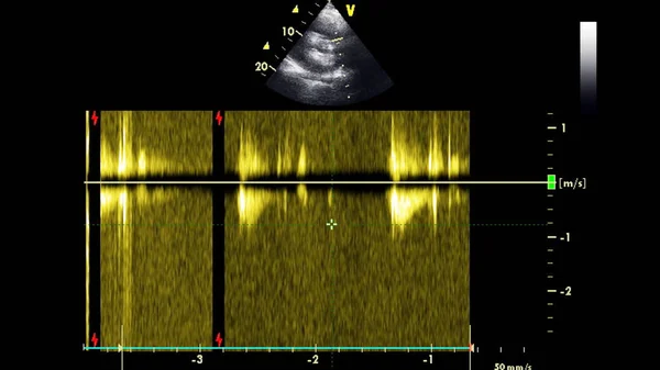 Image of the heart in gray-scale mode during transesophageal ultrasound.