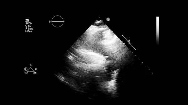 経食道超音波検査時のグレースケールモードで心臓の画像 — ストック写真
