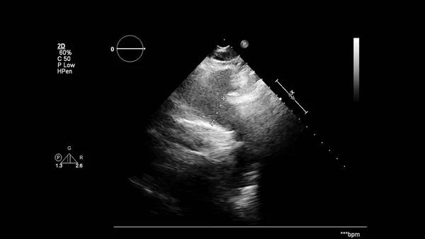 Transesofageal Ultrason Sırasında Kalbin Gri Ölçekli Görüntüsü — Stok fotoğraf