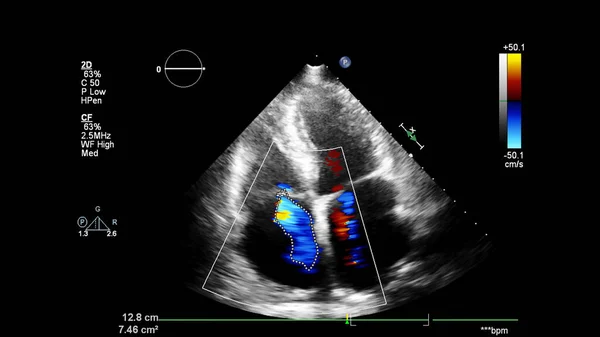 Imagem Coração Durante Ultrassom Transesofágico Com Modo Doppler — Fotografia de Stock