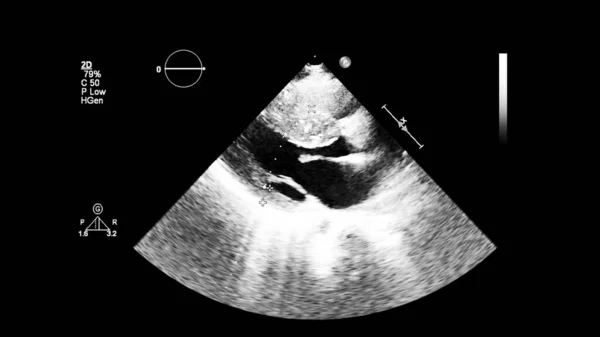 Image Cœur Mode Gris Lors Une Échographie Transœsophagienne — Photo