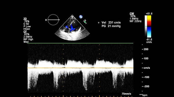 Image of the heart during transesophageal ultrasound with Doppler mode.