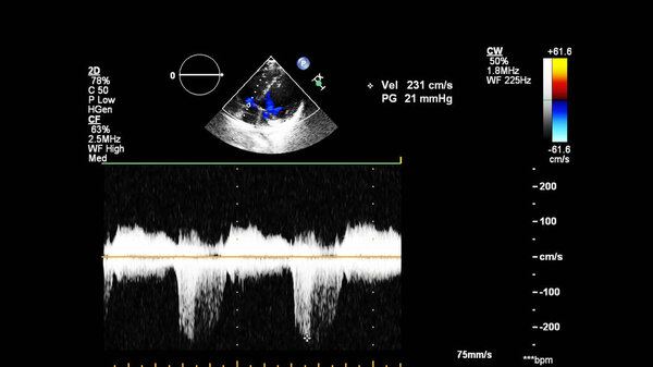 Image of the heart during transesophageal ultrasound with Doppler mode.