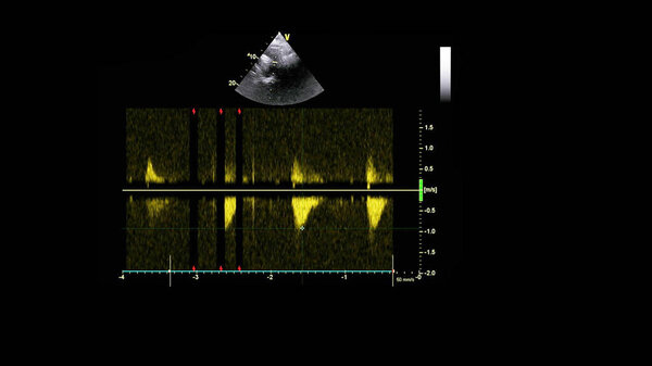Изображение сердца в сером режиме во время трансофагеального ультразвука.