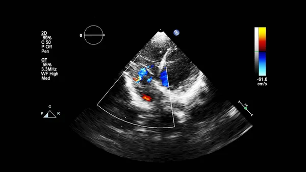 Immagine Del Cuore Durante Ecografia Transesofagea Con Modalità Doppler — Foto Stock