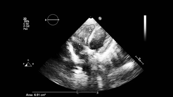 Transesofageal Ultrason Sırasında Kalbin Gri Ölçekli Görüntüsü — Stok fotoğraf