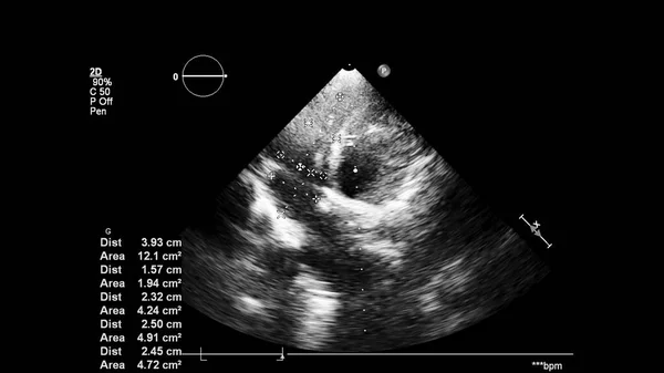 Afbeelding Van Het Hart Grijs Schaal Modus Tijdens Transesofageale Echografie — Stockfoto