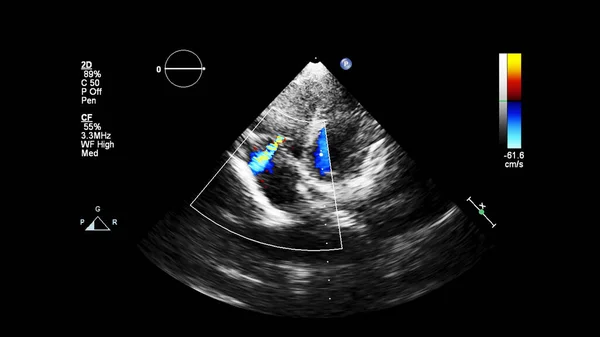 Obrázek Srdce Během Transesofageálního Ultrazvuku Dopplerovým Módem — Stock fotografie