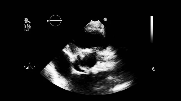 Image Heart Gray Scale Mode Transesophageal Ultrasound — Stock Photo, Image