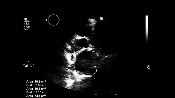 Image of the heart in gray-scale mode during transesophageal ultrasound.