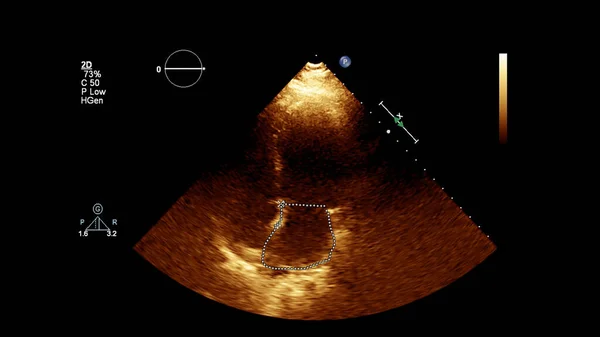 经食管超声下灰度型心脏影像学 — 图库照片