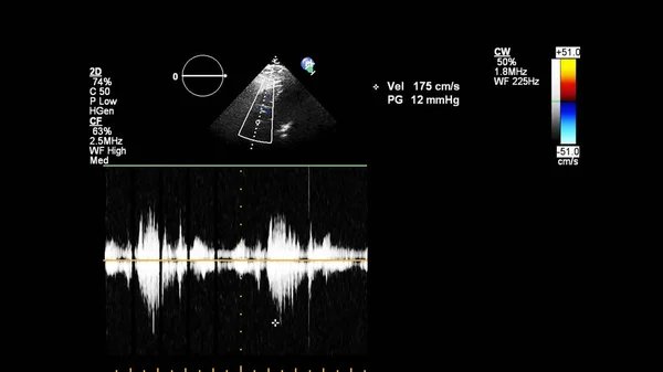 Transesofageal Ultrason Sırasında Doppler Kipi Ile Kalbin Görüntüsü — Stok fotoğraf