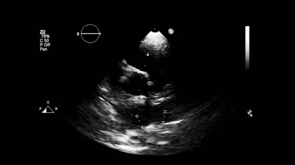 Transesofageal Ultrason Sırasında Kalbin Gri Ölçekli Görüntüsü — Stok fotoğraf