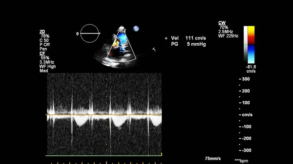 Transesofageal Ultrason Sırasında Kalbin Gri Ölçekli Görüntüsü — Stok fotoğraf