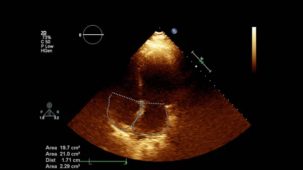 Bild Hjärtat Gråskala Transesofagalt Ultraljud — Stockfoto