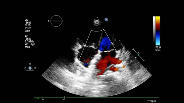 Transesofageal ultrason sırasında Doppler kipi ile kalbin görüntüsü.