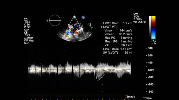 Transesofageal Ultrason Sırasında Doppler Kipi Ile Kalbin Görüntüsü — Stok fotoğraf