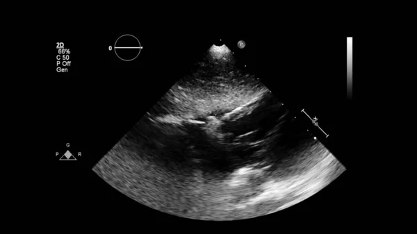 経食道超音波検査時のグレースケールモードで心臓の画像 — ストック写真