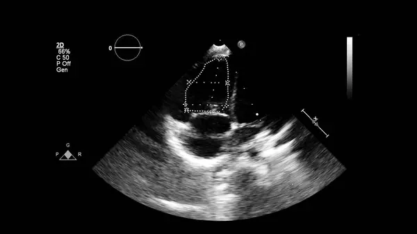 経食道超音波検査時のグレースケールモードで心臓の画像 — ストック写真