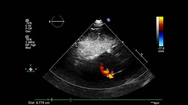 Imagen Del Corazón Durante Ecografía Transesofágica Con Modo Doppler — Foto de Stock