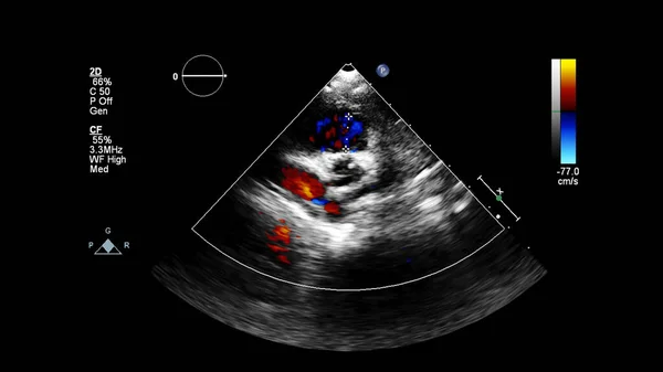 Immagine Del Cuore Durante Ecografia Transesofagea Con Modalità Doppler — Foto Stock