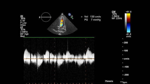 Изображение сердца во время трансофагеального ультразвука с доплеровским режимом.