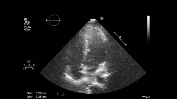 Transesofageal Ultrason Sırasında Kalbin Gri Ölçekli Görüntüsü — Stok fotoğraf