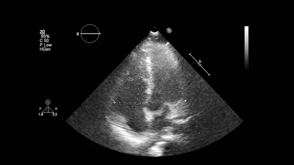 Изображение Сердца Сером Режиме Время Трансофагеального Ультразвука — стоковое фото