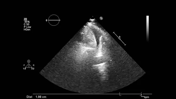 Transesofageal Ultrason Sırasında Kalbin Gri Ölçekli Görüntüsü — Stok fotoğraf