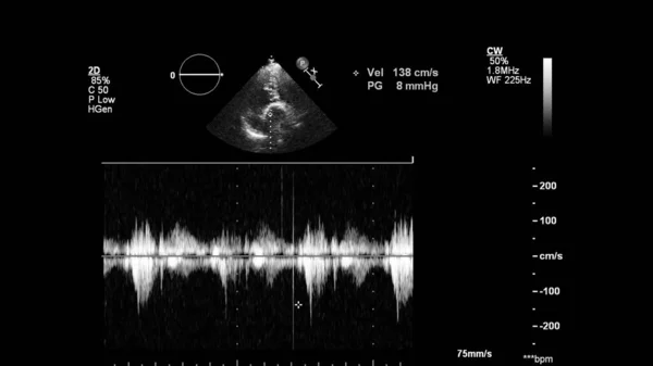 Transesofageal Ultrason Sırasında Kalbin Gri Ölçekli Görüntüsü — Stok fotoğraf