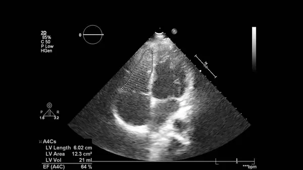 Image Cœur Mode Gris Lors Une Échographie Transœsophagienne — Photo