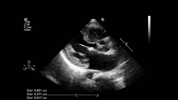 経食道超音波検査時のグレースケールモードで心臓の画像 — ストック写真