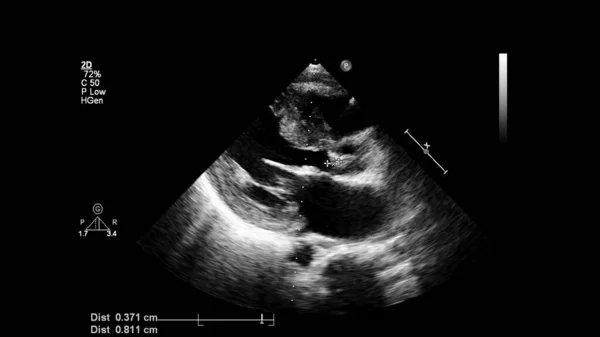 Image Cœur Mode Gris Lors Une Échographie Transœsophagienne — Photo