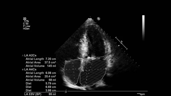 Изображение Сердца Сером Режиме Время Трансофагеального Ультразвука — стоковое фото
