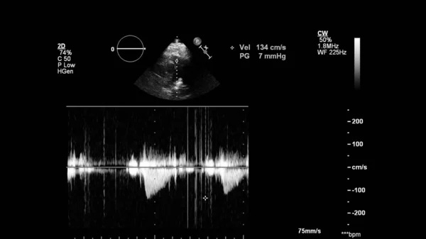 Transesofageal Ultrason Sırasında Kalbin Gri Ölçekli Görüntüsü — Stok fotoğraf