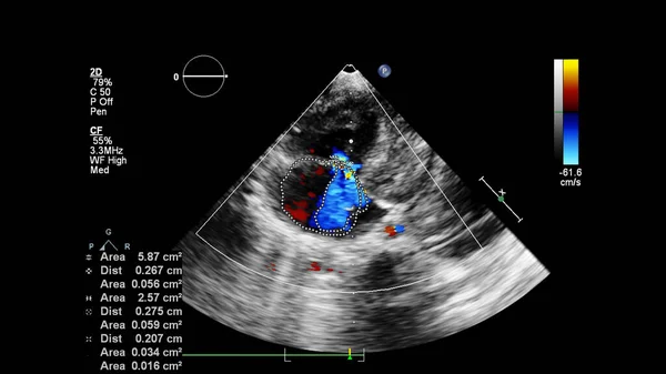 ドップラーモードで経食道超音波中の心臓の画像 — ストック写真