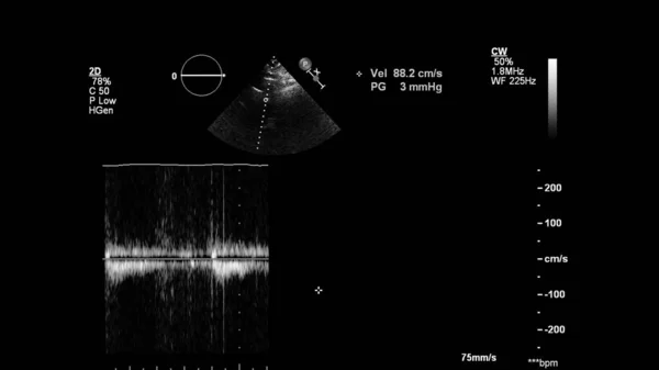 Transesofageal Ultrason Sırasında Kalbin Gri Ölçekli Görüntüsü — Stok fotoğraf