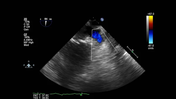 Immagine Del Cuore Durante Ecografia Transesofagea Con Modalità Doppler — Foto Stock