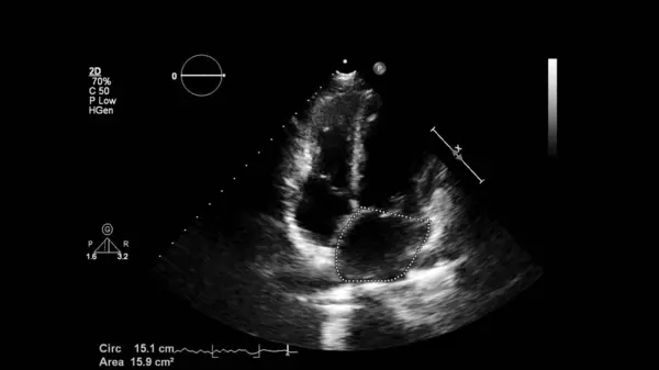 Transesofageal Ultrason Sırasında Kalbin Gri Ölçekli Görüntüsü — Stok fotoğraf