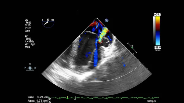 Obrázek Srdce Během Transesofageálního Ultrazvuku Dopplerovým Módem — Stock fotografie