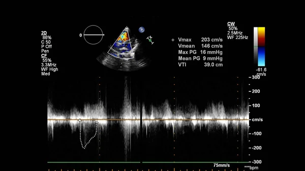 Transesofageal Ultrason Sırasında Doppler Kipi Ile Kalbin Görüntüsü — Stok fotoğraf