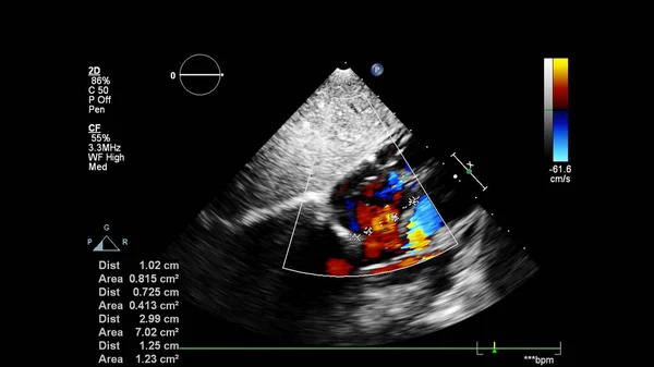 Image Heart Transesophageal Ultrasound Doppler Mode — Stock Photo, Image